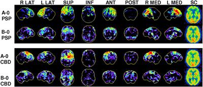 Clinical Routine FDG-PET Imaging of Suspected Progressive Supranuclear Palsy and Corticobasal Degeneration: A Gatekeeper for Subsequent Tau-PET Imaging?